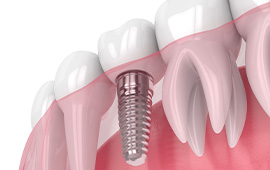 Dental Work in Ho Chi Minh City, Vietnam