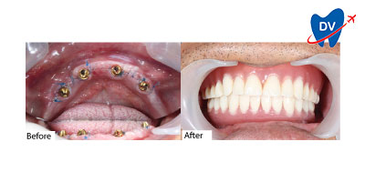 Dental Work in Ho Chi Minh City, Vietnam | Before & After