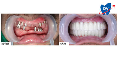 Dental Work in Ho Chi Minh City, Vietnam | Before & After