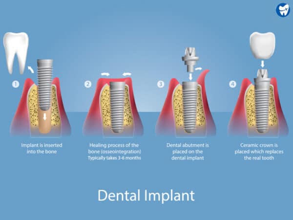 Dental implant procedure