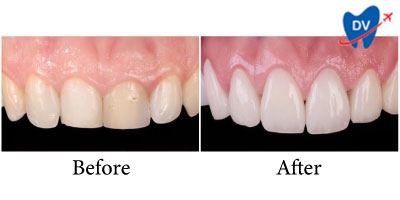 Dental veneers in Hanoi - Before & After