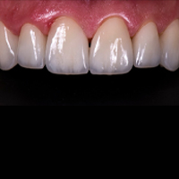 Emax Veneers