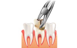 Tooth Extraction