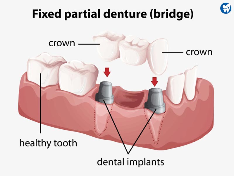 Multiple teeth implant