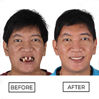 Full Mouth Reconstruction with All on 4 Dental Implants