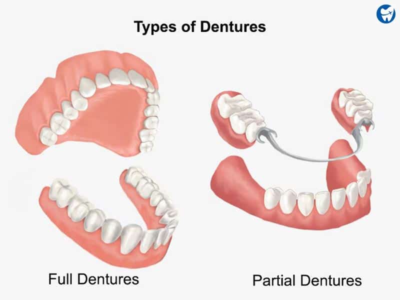 Types of dentures