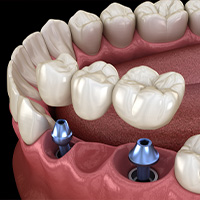 Dental Bridges