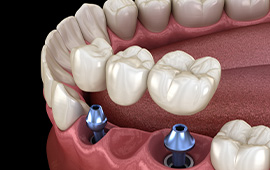 Dental Bridge