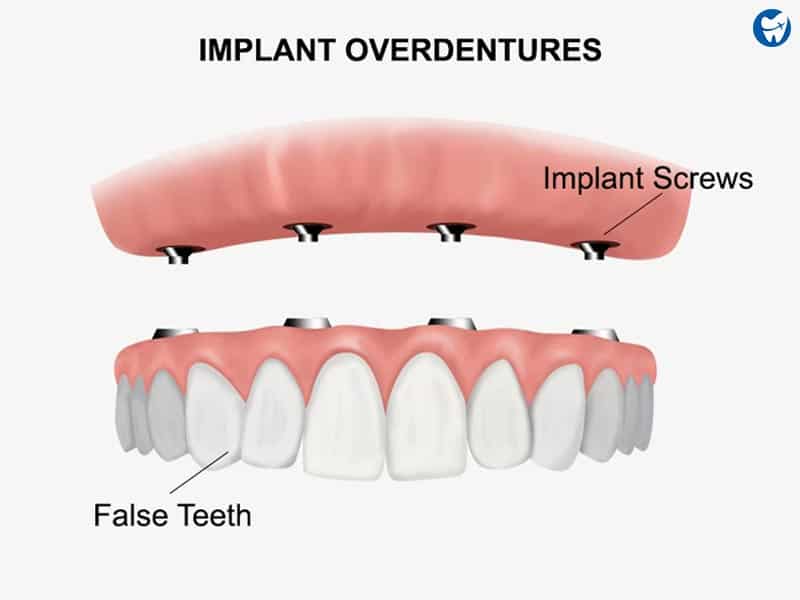 Implant-Supported Dentures