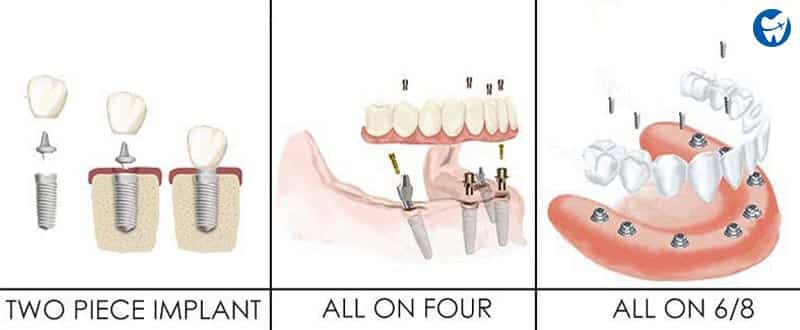 Implant Options