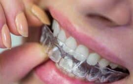 Invisalign