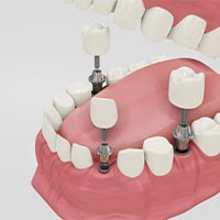 Multiple dental implants in Ho Chi Minh City