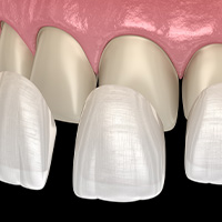 Porcelain Veneers