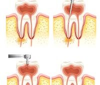 Root Canal