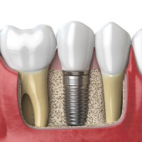 Single dental implant