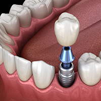 Single dental implant