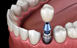 Single Tooth Dental Implant