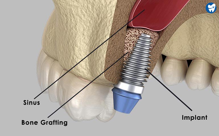 Sinus Lift Cartagena 