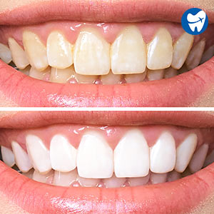 Teeth Whitening in Bangkok