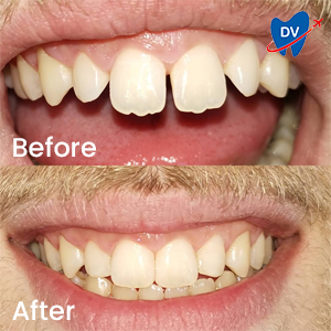 Veneers in Croatia Before & After Reviews