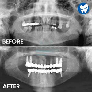 Full mouth restoration 