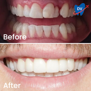 Veneers in Croatia Before & After Reviews