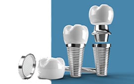 dental Implants