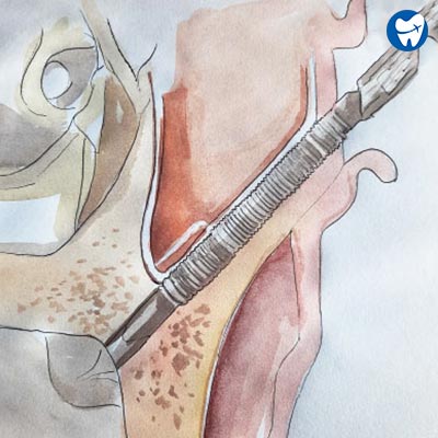 Zygomatic Implants