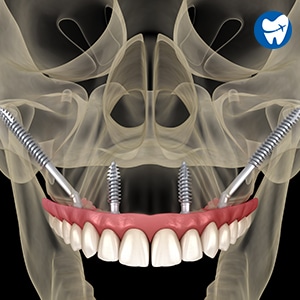 Zygomatic Implants in Izmir, Turkey