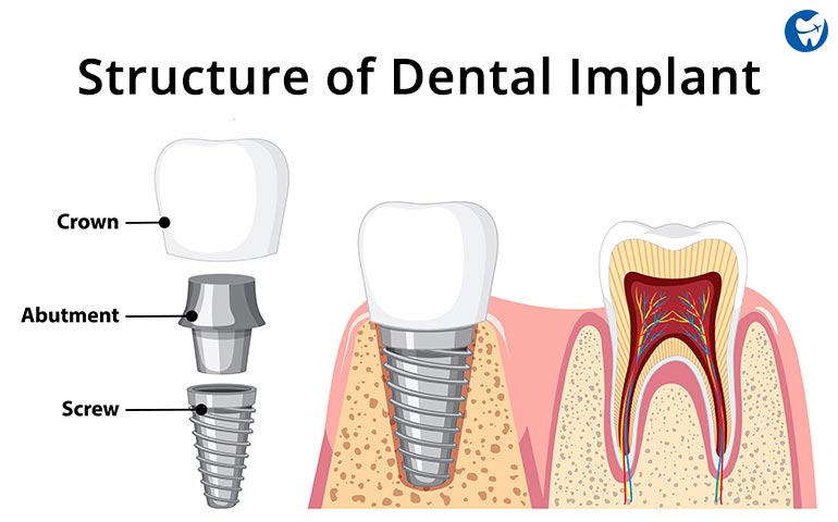 Structure of Dental Implant