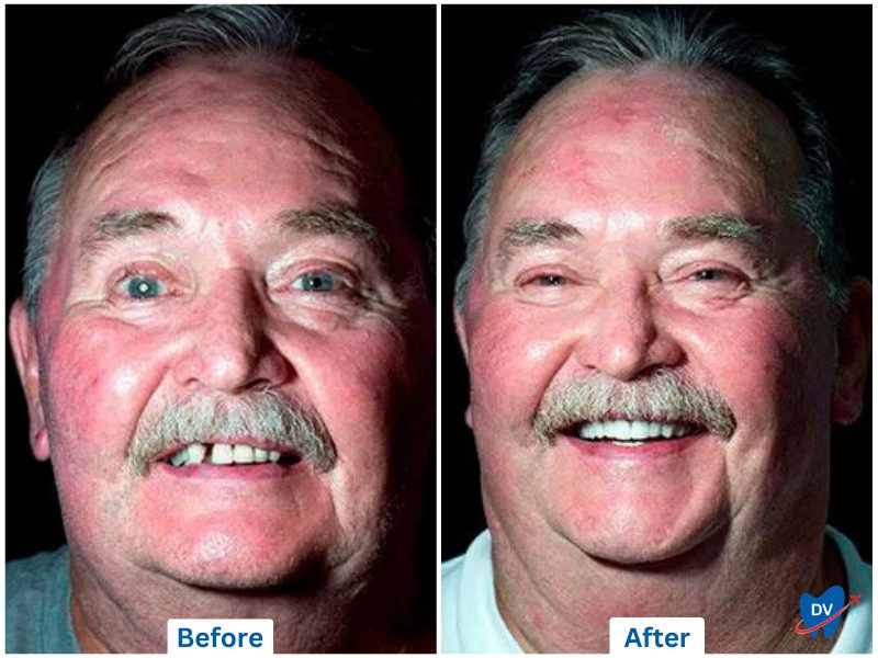 Case of single dental implant at Cancun Dental Specalists, Mexico; a partner clinic of DV.
