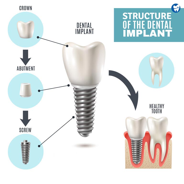 Dental Implants Structure