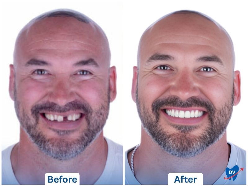 Dental implant restoration at Algodones Dental Center