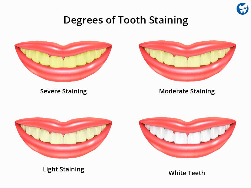 Degrees of tooth staining