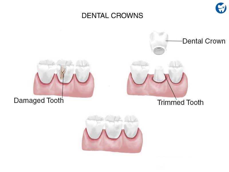 Dental Crown