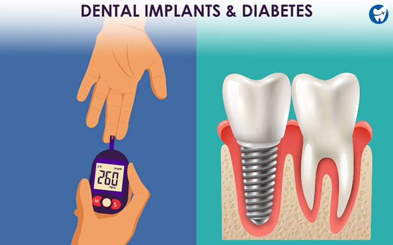 Dental Implants and Diabetes