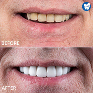 Emax veneers