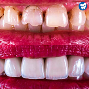 Porcelain veneers