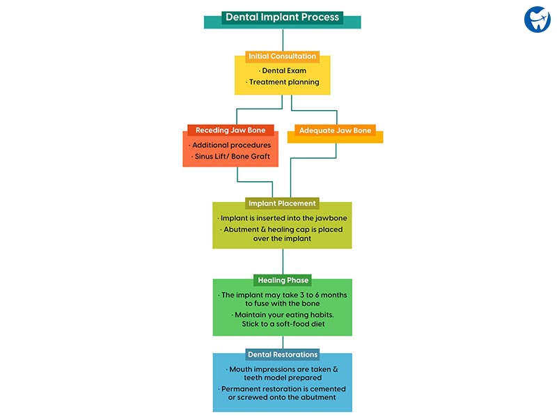 Dental Implant Procedure