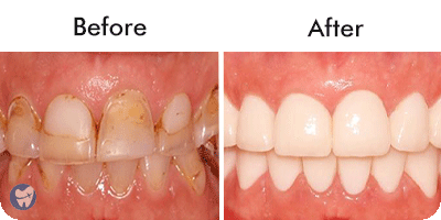 Full mouth rehab with individual crowns