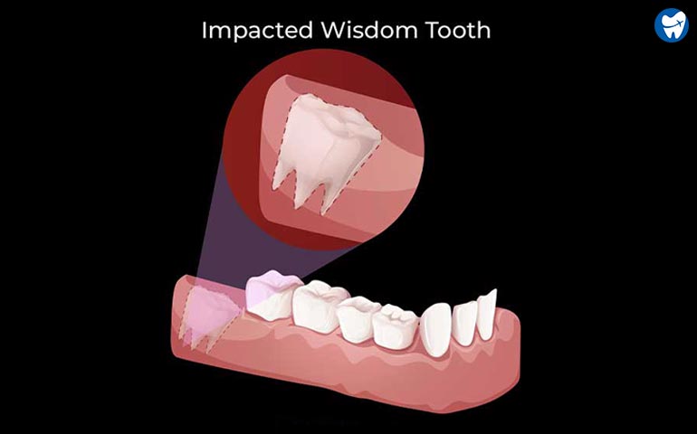 Impaction-of-Wisdom-Tooth