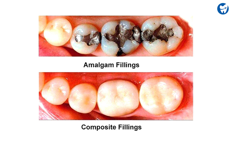 Dental fillings