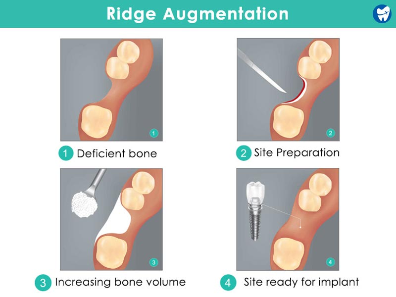 Ridge augmentation