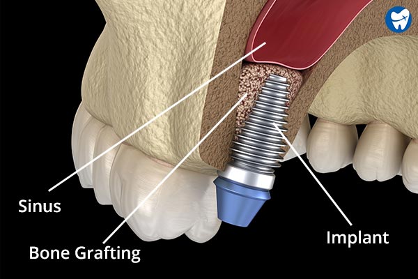 Sinus lift