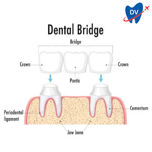 Dental Bridge