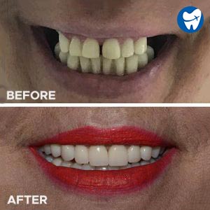 Zirconia crowns - before and after