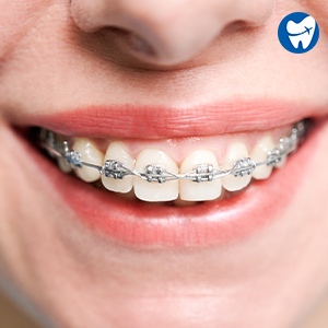 Standard Metal Braces