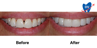 Zirconium Crowns in Albania Before & After