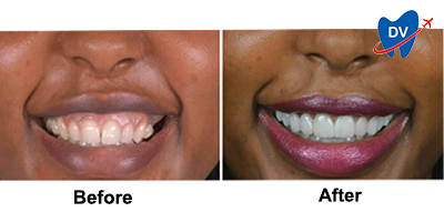 Before & After: Veneers in Brazil 