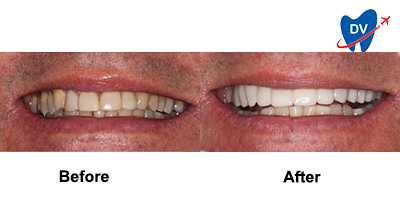 Before & After: Porcelain Veneers in Colombia